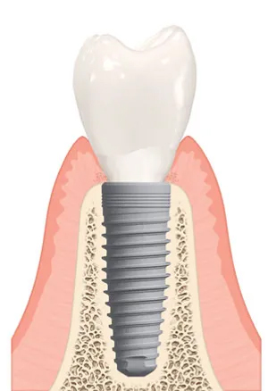 Bone Graft